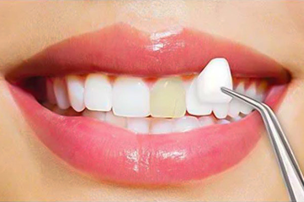 Is Dental Veneers Good for Your Teeth?